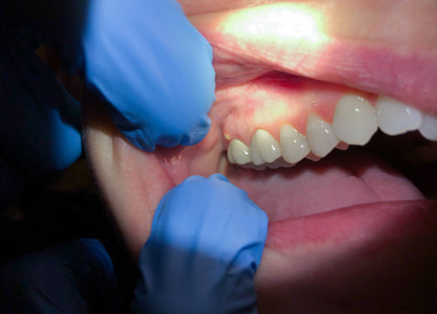Best Knocked-Out Tooth Emergency  in Bellair Meadowbrook Terrace, FL